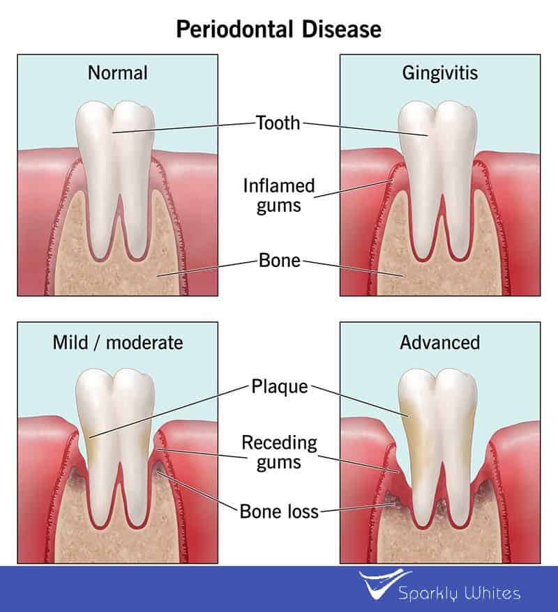 Can Gum Bleeding Really Indicate Poor Oral Hygiene Harlow?