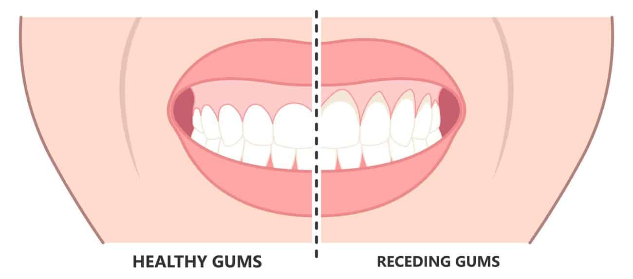 What Causes Gums to Recede Over Time Harlow